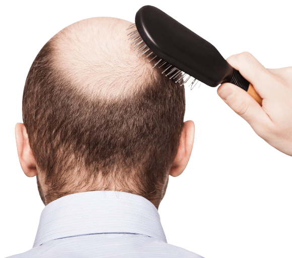 Balding man