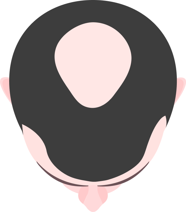 Thinning crown